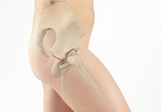 Direct Superior Hip Replacement