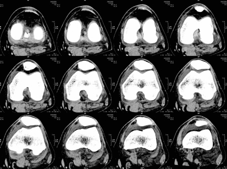 CT Scan
