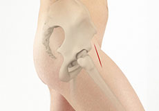 Anterior Hip Replacement