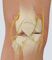 Iovera Non-opioid Nerve Block (Immediate and Long-lasting)
