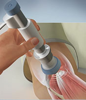 Radial Shockwave Therapy
