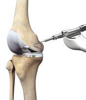 Robotic Joint Replacement Surgery