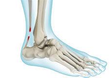 Achilles Rupture