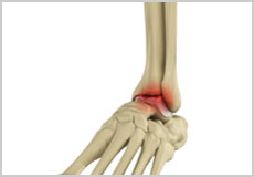 Foot and Ankle Arthritis