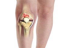 Knee Arthritis