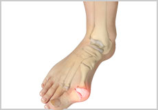 Bunion Surgery