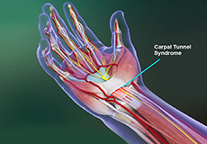 Carpal Tunnel Syndrome