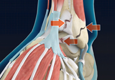 Complex Foot and Ankle Surgeries