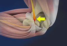 Ulnar Nerve Entrapment (Cubital Tunnel Syndrome)