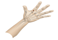 Fractures of the Hand and Fingers
