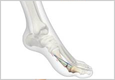 Minimally invasive bunion surgery