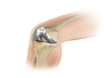 Minimally Invasive Total Knee Arthroplasty