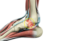 Perineal Tendinitis