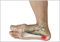 Plantar Fasciitis