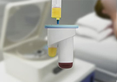 Platelet Rich Plasma