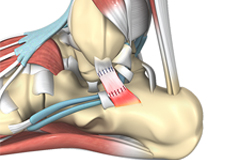 Revision Foot and Ankle Surgery