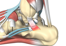 Revision Foot and Ankle Surgery