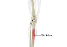 Shin Splints