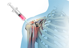 Stem Cell Therapy