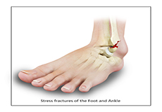 Stress Fracture of the Foot