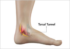 Stress Fracture of the Foot