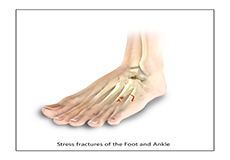 Toe and Forefoot Fractures