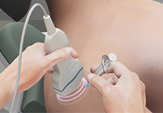 Ultrasound Guided Shoulder Injections